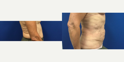 Liposuction before and after photo