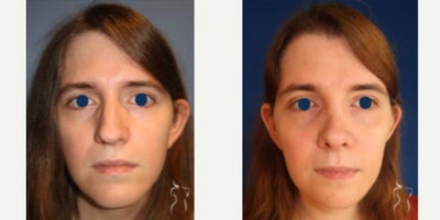 Rhinoplasty before and after photo