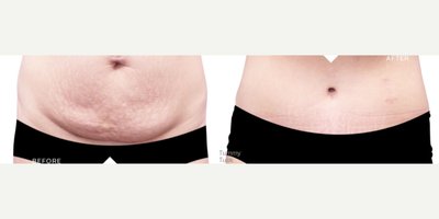 Tummy Tuck before and after photo