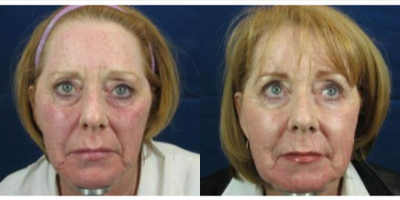 CO2 Laser before and after photo
