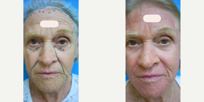 CO2 Laser before and after photo