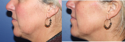 Dermal Fillers before and after photo