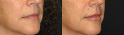 Dermal Fillers before and after photo