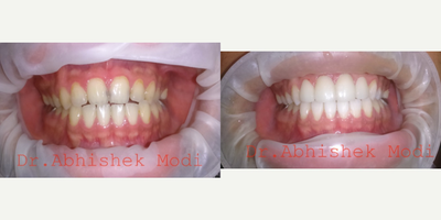 Porcelain Veneers before and after photo