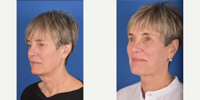 Ultherapy before and after photo