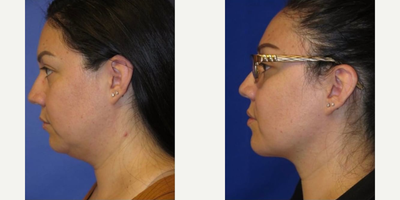 Buccal Fat Removal before and after photo