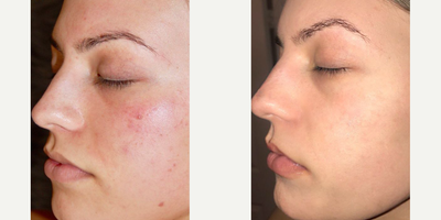 Chemical Peel before and after photo