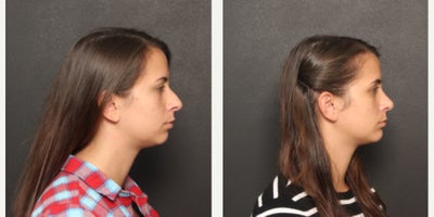 Chin Implant before and after photo