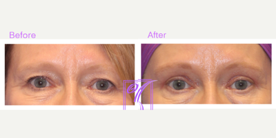 Eyelid Surgery before and after photo