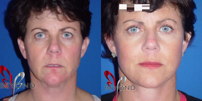 Facelift before and after photo