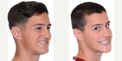 Jaw Surgery before and after photo