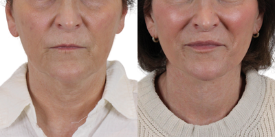 Lip Fillers before and after photo