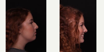 Rhinoplasty before and after photo