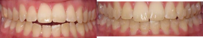 Invisalign before and after photo