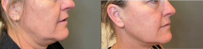 Kybella before and after photo