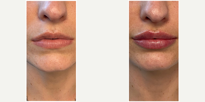 Lip Fillers before and after photo