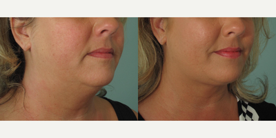 Liposuction before and after photo