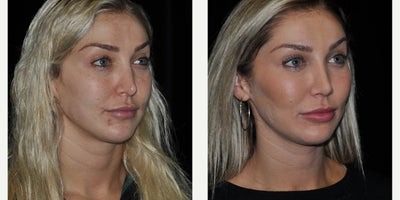 Liposuction before and after photo
