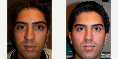 Restylane before and after photo