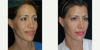 Rhinoplasty before and after photo