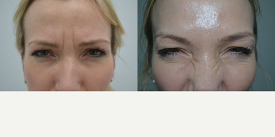 Botox before and after photo