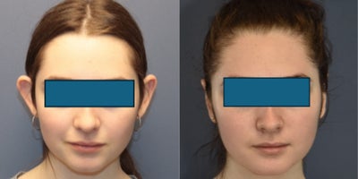 Ear Surgery before and after photo