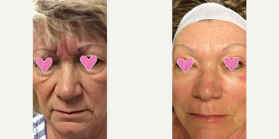 Botox before and after photo