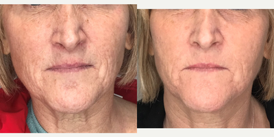 before and after image