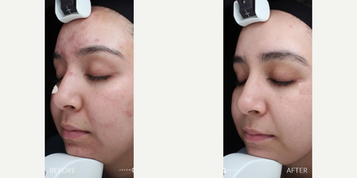 Accutane before and after photo
