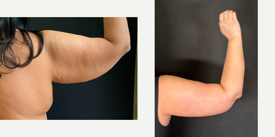 Arm Lift before and after photo