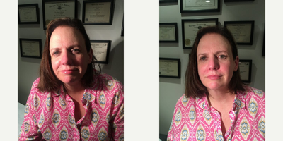 Botox before and after photo