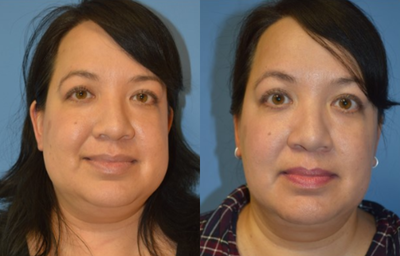 Buccal Fat Removal before and after photo