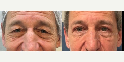 Double Eyelid Surgery before and after photo