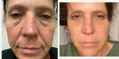 Eyelid Surgery before and after photo