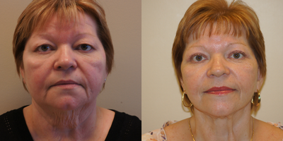 Facelift before and after photo