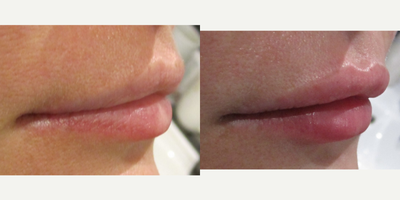 Lip Fillers before and after photo