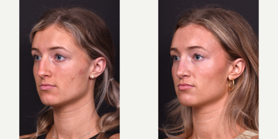 Rhinoplasty before and after photo