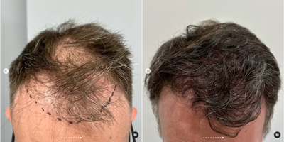 Hair Loss Treatment before and after photo