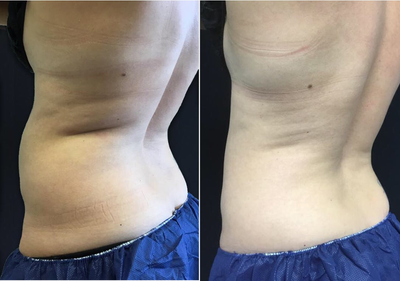 CoolSculpting before and after photo
