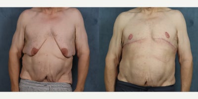 Gynecomastia Surgery before and after photo