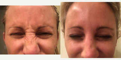 Botox before and after photo
