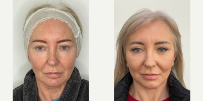 CO2 Laser before and after photo