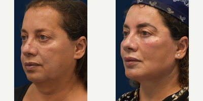 Deep Plane Facelift before and after photo