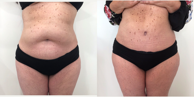 Drainless Tummy Tuck before and after photo