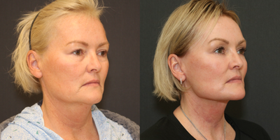 Facelift before and after photo