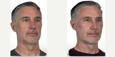 Mini Facelift before and after photo