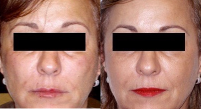 Radiesse before and after photo
