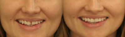 Dental Bonding before and after photo