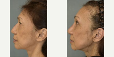 Eyelid Surgery before and after photo