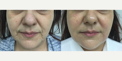 Radiesse before and after photo